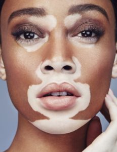Model Winnie Harlow