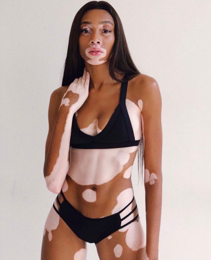 Winnie Harlow
